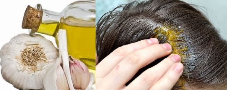 علاج تساقط الشعر بالثوم