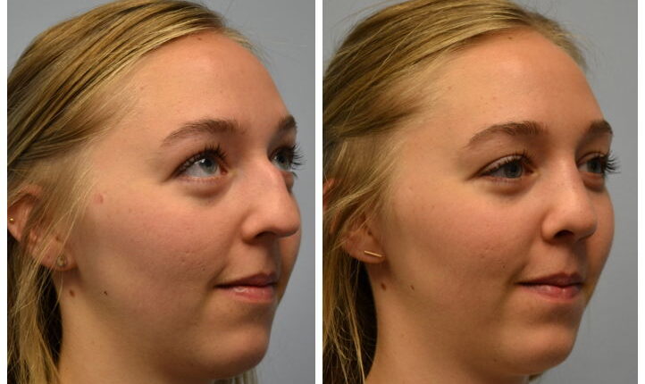 سعر عملية تجميل الأنف في الرياض