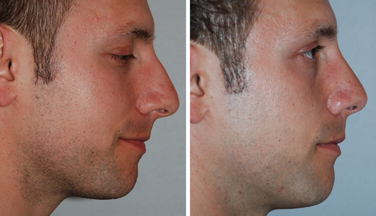 تجربتي مع عملية تجميل الأنف