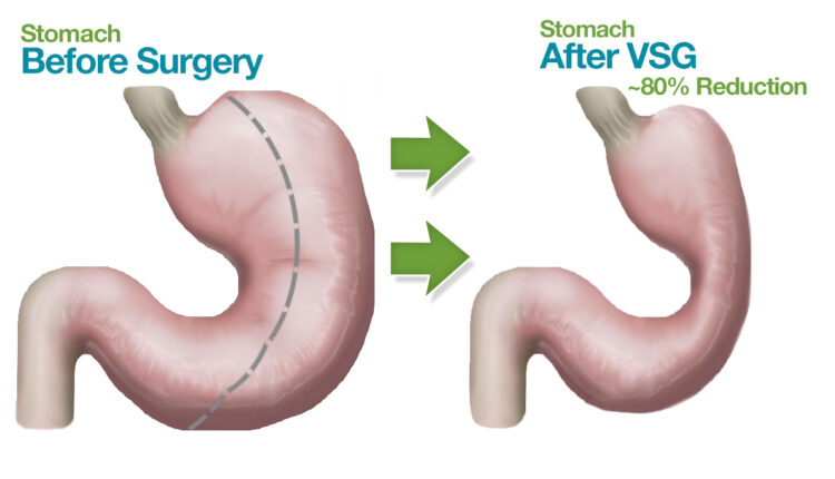 عملية تصغير المعدة