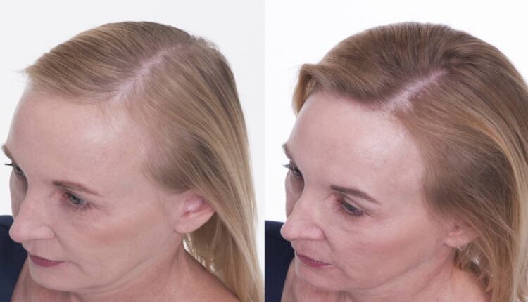 تساقط الشعر من الجذور البيضاء