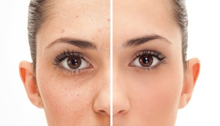 كريم لتفتيح البشرة السمراء في اسبوع