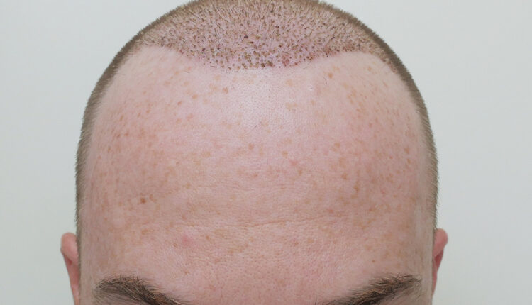 زراعة الشعر في فرنسا