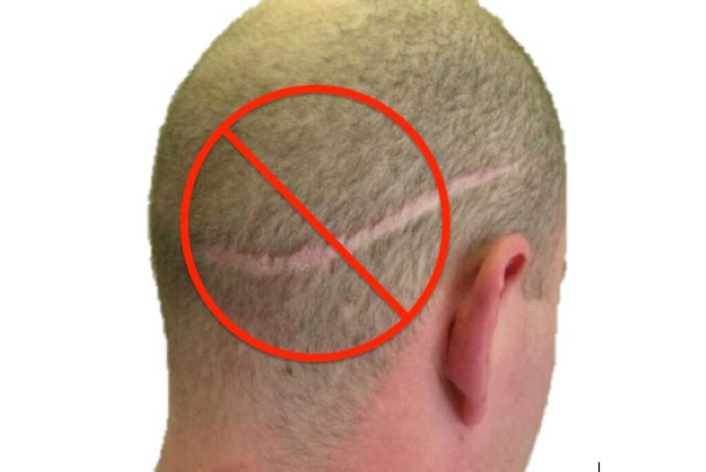 تكلفة زراعة الشعر في تركيا 2022