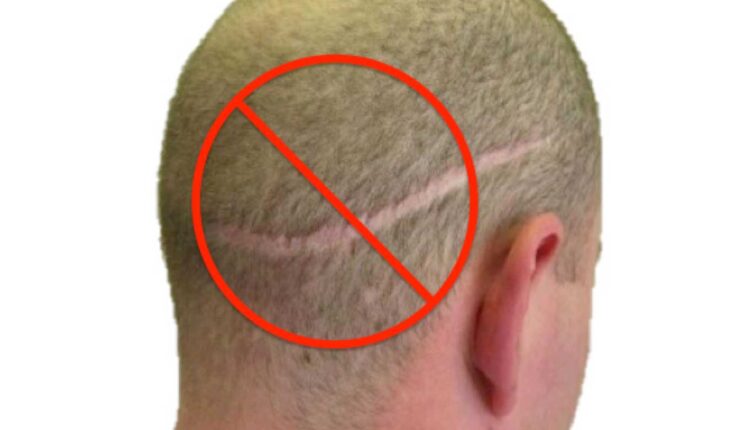 تكلفة زراعة الشعر في تركيا 2022