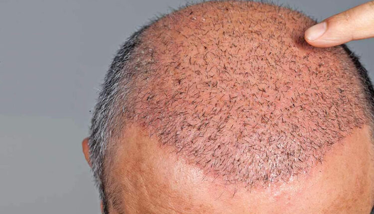 افضل مراكز زراعة الشعر في تركيا