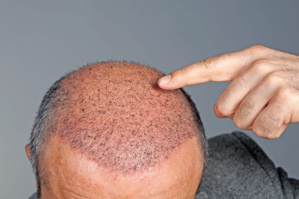 افضل دكتور زراعة شعر في المانيا 