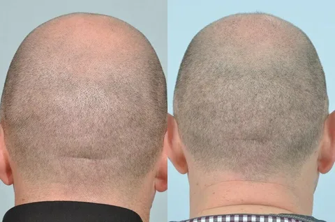 زراعة الشعر في باريس