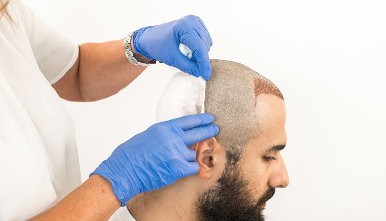 زراعة الشعر في أمريكا 2022