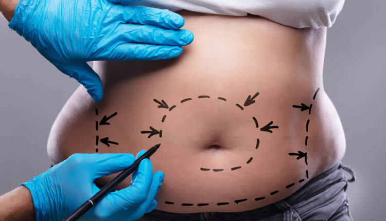 عملية شد البطن في دبي