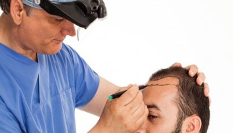 أفضل دكاترة زراعة الشعر في تركيا