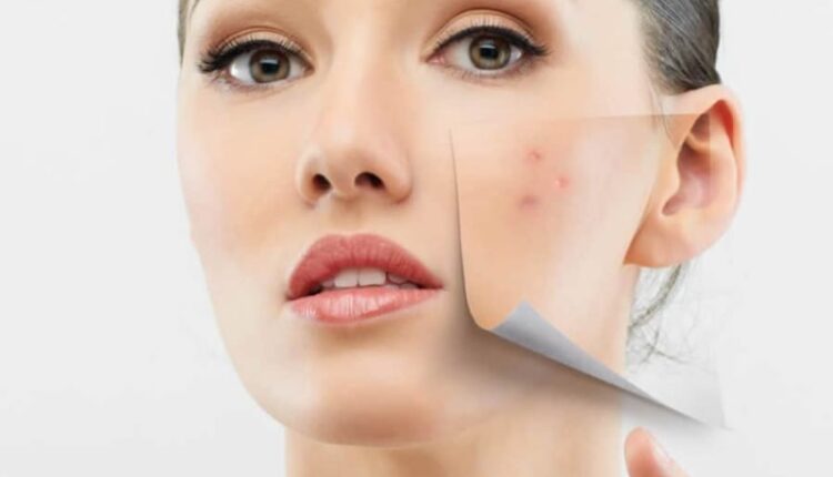 كيف ازيل حب الشباب