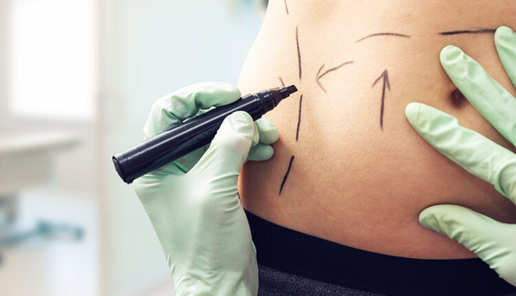 سعر عملية الفيزر