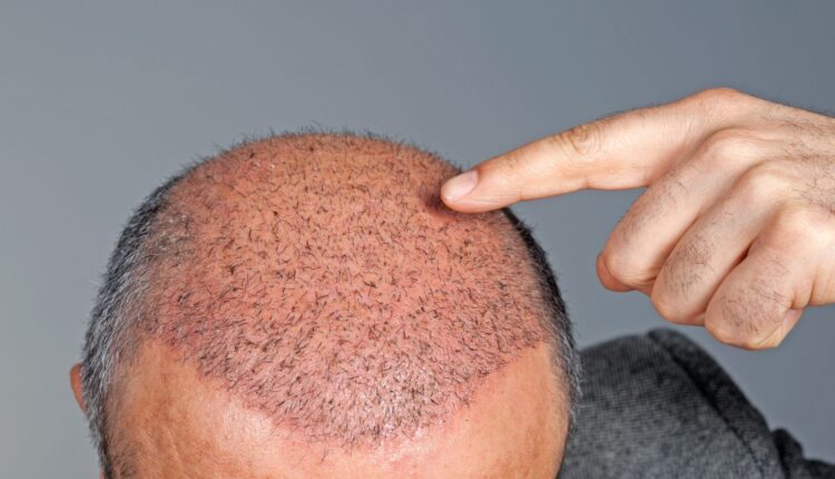 أفضل مراكز زراعة الشعر في تركيا 2022
