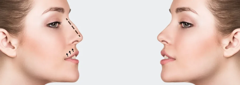 أسعار عمليات تجميل الأنف في السعودية 