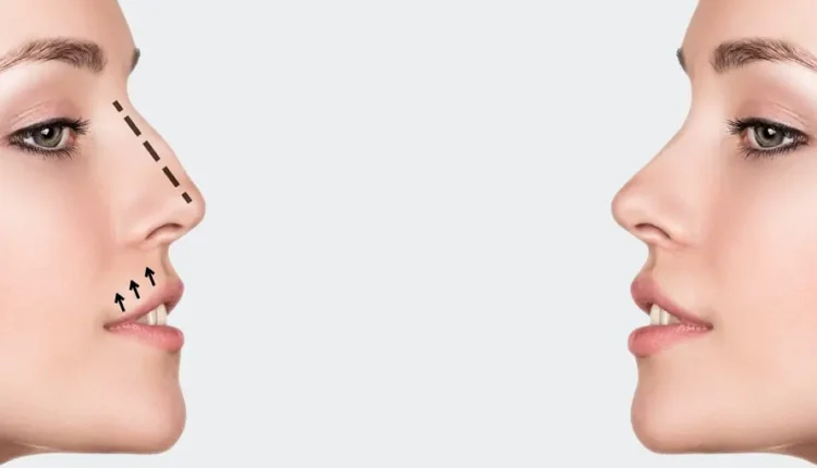 عملية تجميل الأنف في الكويت