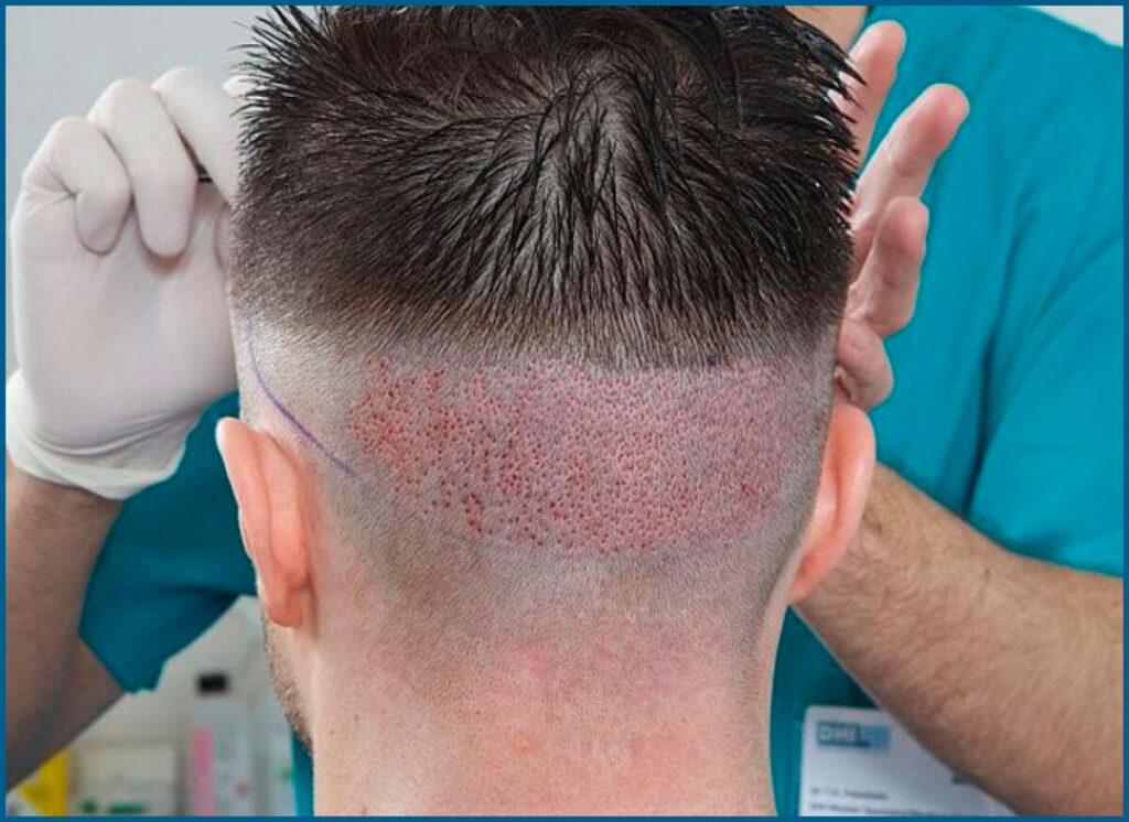 أفضل تقنية لزراعة الشعر