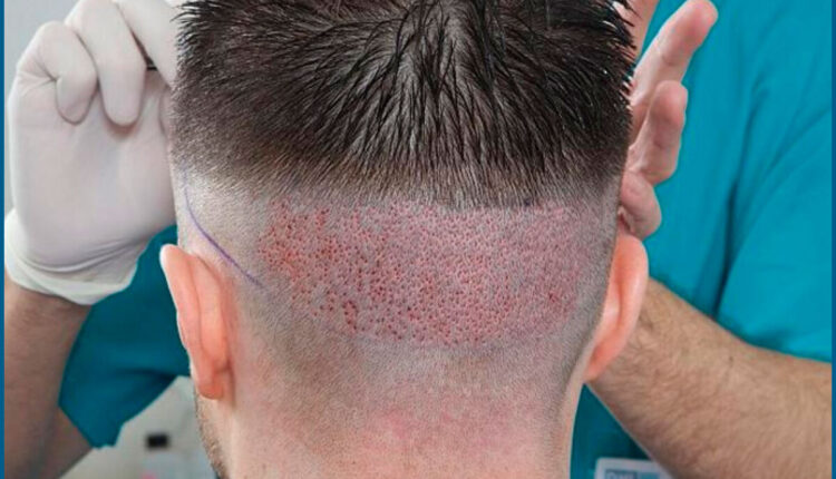 أفضل تقنية لزراعة الشعر