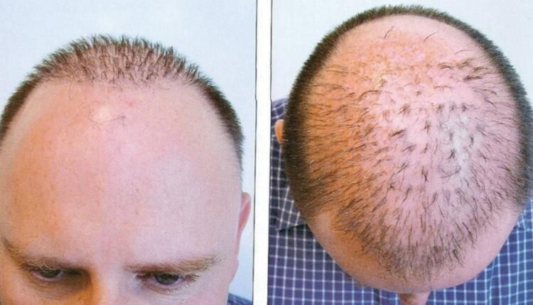 زراعة الشعر في ابوظبي