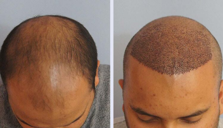 زراعة الشعر في دبي