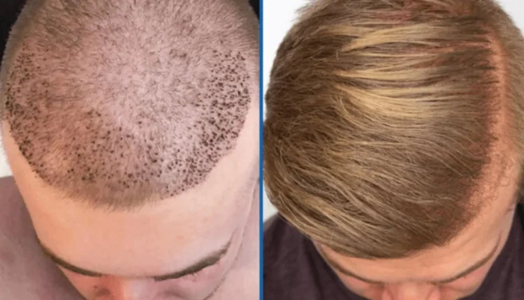 تكلفة زراعة الشعر في الامارات