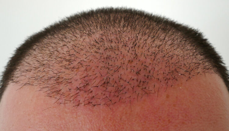 تجربتي مع زراعة الشعر في الرياض