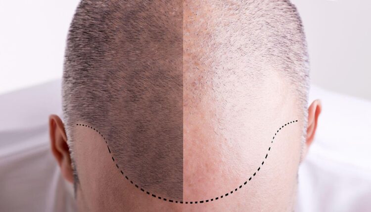 زراعة الشعر في تركيا إسطنبول