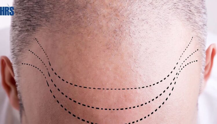 افضل مراكز زراعة الشعر في دبي