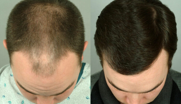 تجربتي مع زراعة الشعر