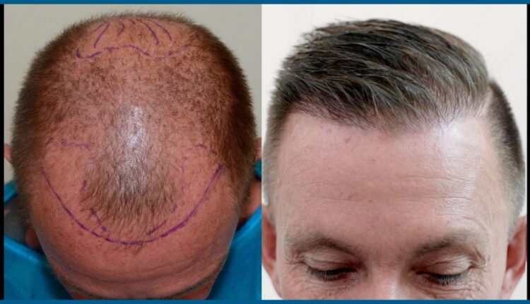 تكلفة زراعة الشعر في تركيا بالريال السعودي