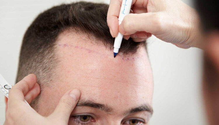 تكلفة زراعة الشعر في تركيا 2022