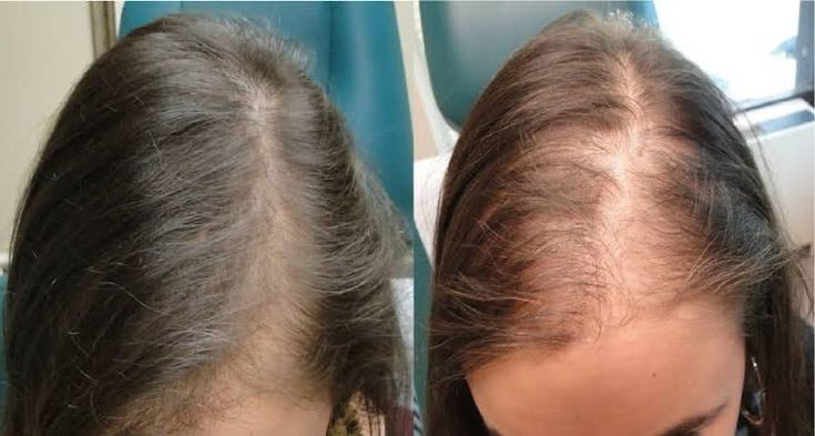 زراعة الشعر للنساء في تركيا