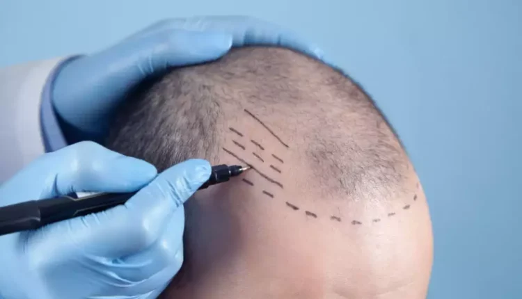 تجربتي في زراعة الشعر في دبي