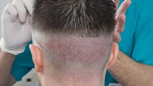أفضل أطباء زراعة الشعر في أمريكا