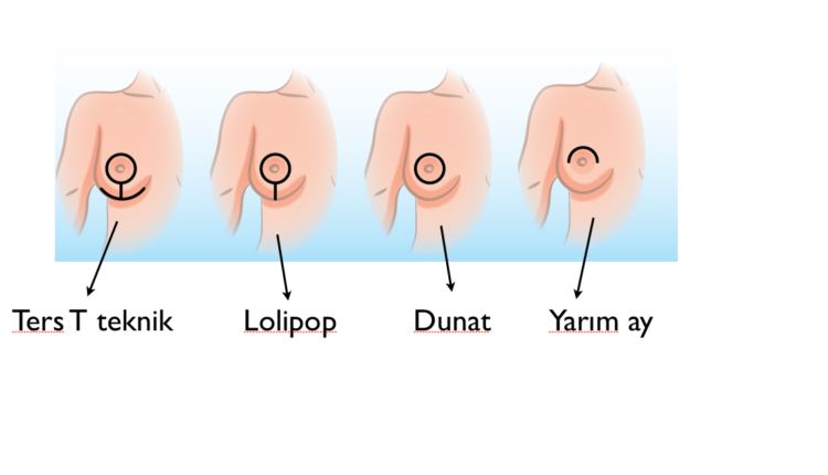 تكلفة عملية تصغير الثدي في السعودية