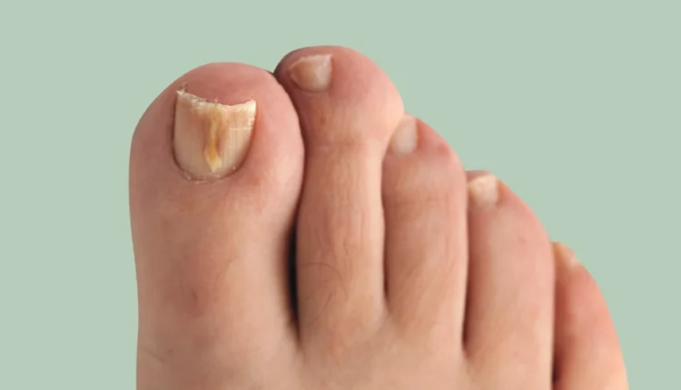 أسباب وأعراض فطريات الأظافر وطرق العلاج